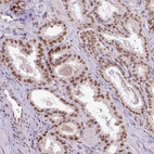 Immunohistochemical staining of human prostate cancer shows moderate to strong nuclear positivity in tumor cells.