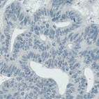 Immunohistochemical staining of human colorectal cancer shows absence of positivity in tumor cells (negative control).