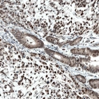 Immunohistochemical staining of human stomach cancer shows moderate to strong nuclear positivity in tumor cells.