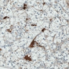 Immunohistochemical staining of human kidney (renal cancer) shows strong positivity in plasma in blood vessels.