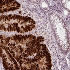 Immunohistochemical staining of human colorectal cancer shows strong nuclear positivity in tumor cells, but not in normal mucosa.