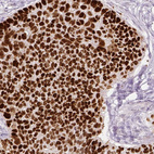 Immunohistochemical staining of human lung cancer (squamous cell carcinoma) shows strong nuclear positivity in tumor cells.