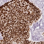 Immunohistochemical staining of human lung cancer (squamous cell carcinoma) shows strong nuclear positivity in tumor cells.