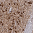 Immunohistochemical staining of human substantia nigra shows strong cytoplasmic positivity in dopaminergic neurons.