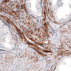 Immunohistochemical staining of human smooth muscle in prostate shows strong membranous positivity in myocytes.