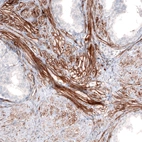 Immunohistochemical staining of human smooth muscle in prostate shows strong membranous positivity in myocytes.