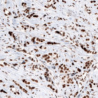 Immunohistochemical staining of human breast cancer shows strong nuclear positivity in tumor cells.