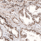 Immunohistochemical staining of human prostate cancer shows strong nuclear positivity in tumor cells.