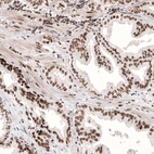 Immunohistochemical staining of human prostate cancer shows strong nuclear positivity in tumor cells.