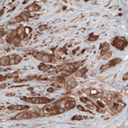 Immunohistochemical staining of human breast cancer shows cytoplasmic immunoreactivity in tumor cells.