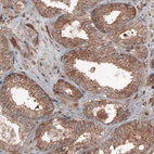 Immunohistochemical staining of human prostate cancer shows moderate cytoplasmic positivity in tumor cells.