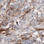 Immunohistochemical staining of human lung cancer shows strong immunoreactivity in a subset of cells.