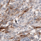 Immunohistochemical staining of human lung cancer shows strong immunoreactivity in a subset of cells.