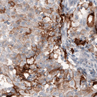 Immunohistochemical staining of human lung cancer shows strong immunoreactivity in a subset of cells.