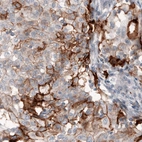 Immunohistochemical staining of human lung cancer shows strong immunoreactivity in a subset of cells.