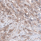 Immunohistochemical staining of human breast cancer shows moderate cytoplasmic positivity in tumor cells.