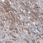 Immunohistochemical staining of human breast cancer shows moderate cytoplasmic immunoreactivity in tumor cells.