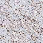Immunohistochemical staining of human breast cancer shows moderate nuclear positivity in tumor cells.