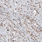 Immunohistochemical staining of human breast cancer shows moderate nuclear positivity in tumor cells.