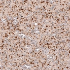 Immunohistochemical staining of human glioma shows moderate to strong nuclear positivity in tumor cells.
