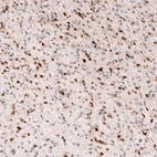 Immunohistochemical staining of human glioma shows moderate to strong nuclear positivity in tumor cells.