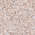 Immunohistochemical staining of human glioma shows moderate to strong nuclear positivity in tumor cells.