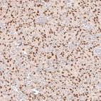 Immunohistochemical staining of human glioma shows moderate to strong nuclear positivity in tumor cells.