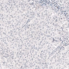 Immunohistochemical staining of human bladder cancer shows absence of positivity in tumor cells as expected (negative control).