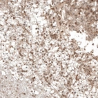Immunohistochemical staining of human renal cancer shows moderate cytoplasmic positivity.