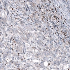 Immunohistochemical staining of human breast cancer shows moderate positivity.