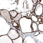 Immunohistochemical staining of human thyroid gland shows strong positivity in cytoplasm granular in glandular cells.