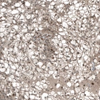 Immunohistochemical staining of human renal cancer shows moderate to strong nuclear positivity in tumor cells.