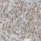 Immunohistochemical staining of human breast cancer shows moderate to strong nuclear positivity in tumor cells.