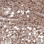 Immunohistochemical staining of human liver cancer shows strong nuclear positivity in tumor cells.