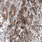 Immunohistochemical staining of human stomach cancer shows moderate to strong cytoplasmic and nuclear positivity.