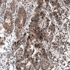 Immunohistochemical staining of human stomach cancer shows moderate to strong cytoplasmic and nuclear positivity.