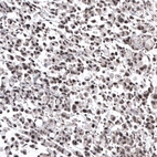 Immunohistochemical staining of human stomach cancer shows moderate nuclear positivity.