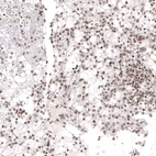Immunohistochemical staining of human renal cancer shows moderate nuclear positivity.