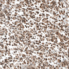 Immunohistochemical staining of human stomach cancer shows moderate cytoplasmic positivity in tumor cells.