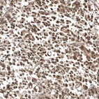Immunohistochemical staining of human stomach cancer shows moderate cytoplasmic positivity in tumor cells.