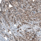 Immunohistochemical staining of human breast cancer shows moderate cytoplasmic positivity.