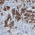 Immunohistochemical staining of human breast cancer shows strong cytoplasmic positivity in tumor cells.