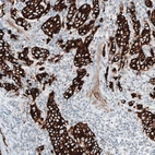 Immunohistochemical staining of human breast cancer shows strong cytoplasmic positivity in tumor cells.