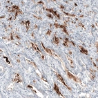 Immunohistochemical staining of human stomach cancer shows strong positivity in secretion.