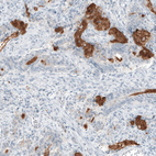 Immunohistochemical staining of human stomach cancer shows strong positivity in mucus.