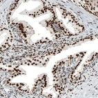 Immunohistochemical staining of human prostate cancer shows strong nuclear positivity in tumor cells.