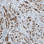 Immunohistochemical staining of human breast cancer shows strong nuclear positivity in tumor cells.