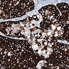 Immunohistochemical staining of human lung cancer, squamous cell carcinoma shows strong cytoplasmic positivity.