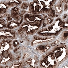 Immunohistochemical staining of human prostate cancer shows strong cytoplasmic positivity in glandular cells.