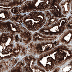 Immunohistochemical staining of human prostate cancer shows strong cytoplasmic positivity in glandular cells.